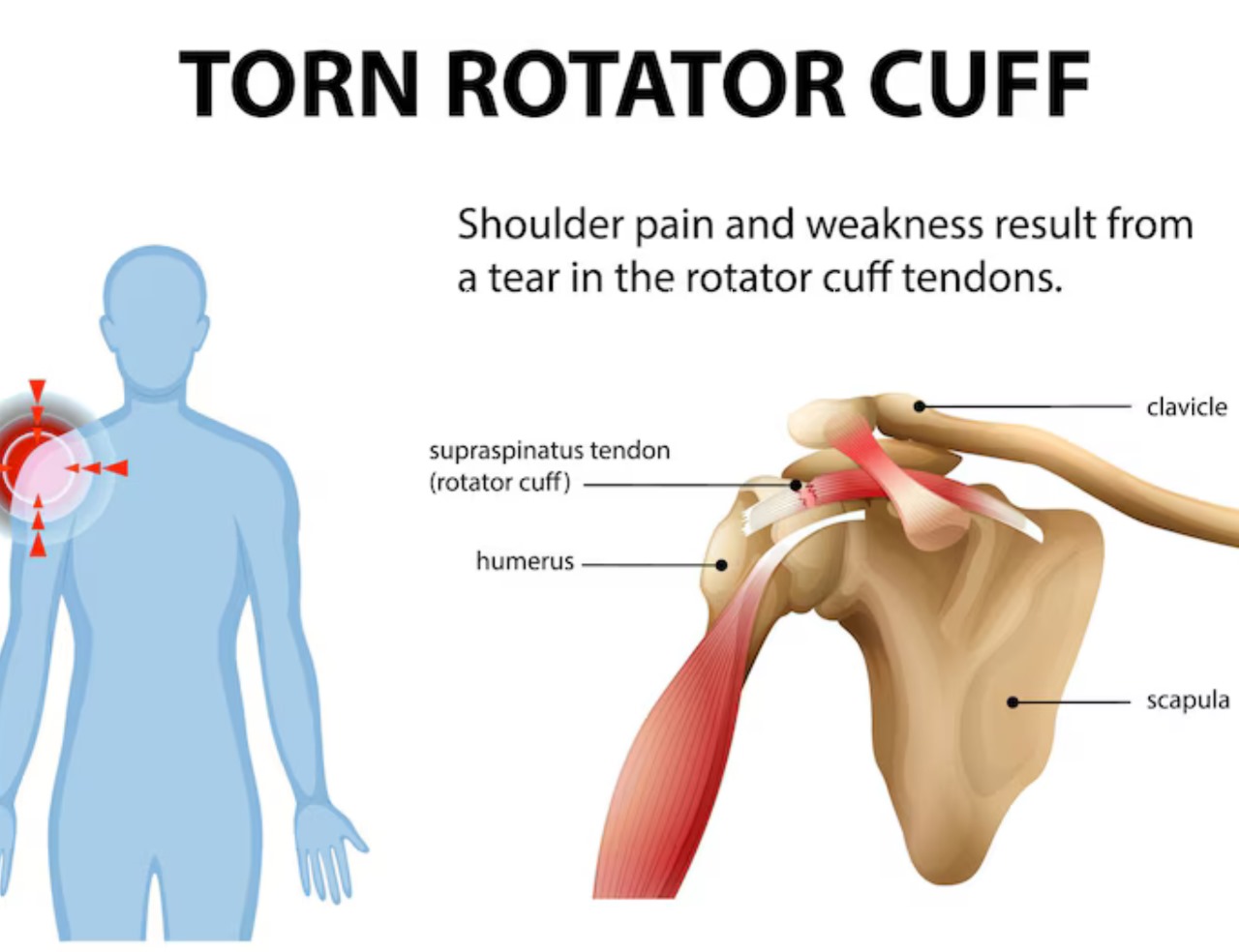 Rotator cuff tear arthroscopic surgery by Dr. Vishal Mandlewala in Surat