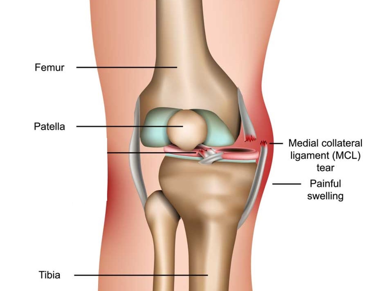 medial collateral ligament (MCL)